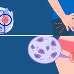 زگیل تناسلی چیست؟